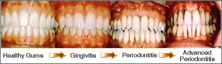 disease reverse periodontal gingivitis gum gums healthy