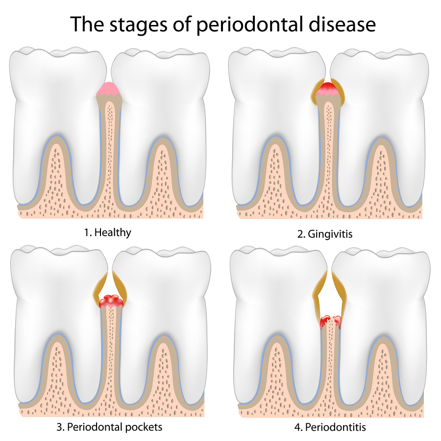 Periodontal Disease - Causes, Symptoms, Treatment